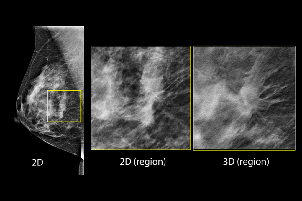 Imagens clínicas de mamografia com lesão suspeita