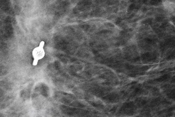 Mamografia que exibe o marcador de biopsia