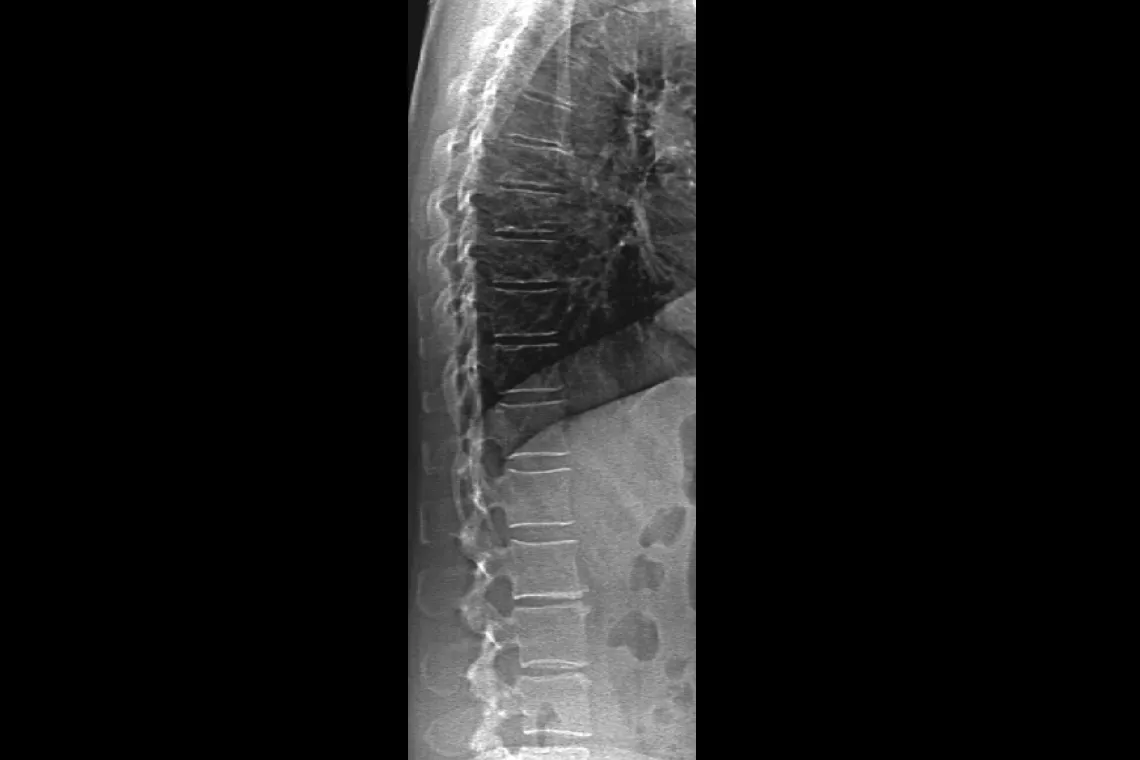 radiografia da coluna