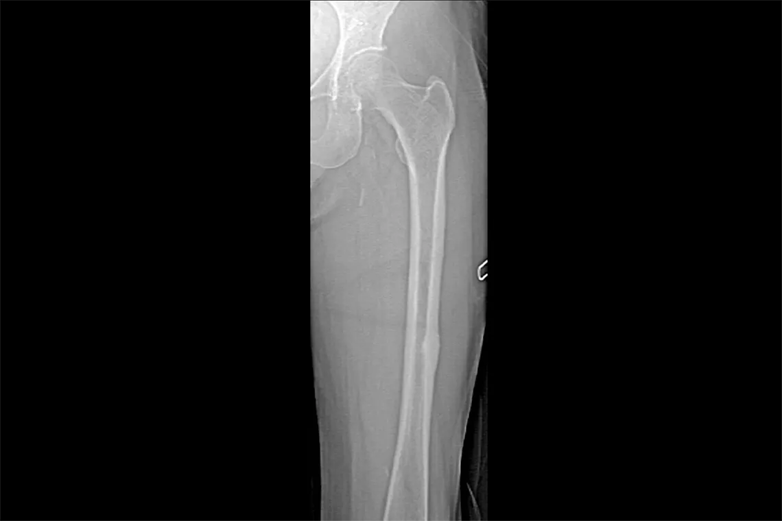 radiografia do fémur