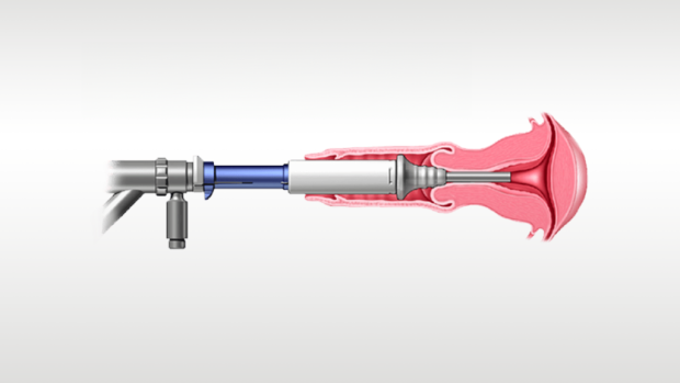 Ilustração do dispositivo médico em utilização.